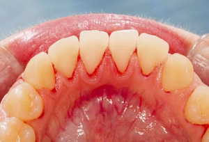 Encías dañadas por periodoncia
