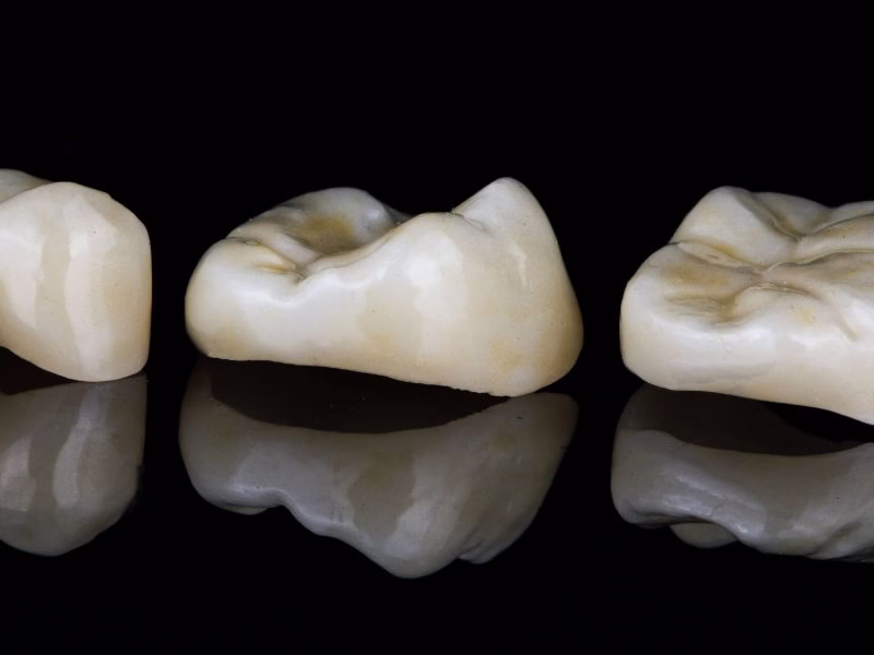 Coronas e incrustaciones