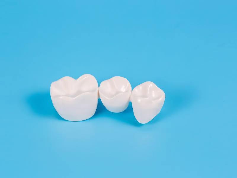 Coronas e incrustaciones